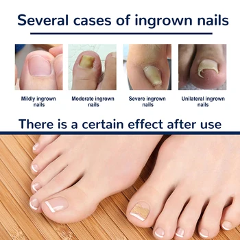 Етикети за лечение на врастнали нокти на краката, инструмент за педикюр и грижи за нокти за мъже-унисекс
